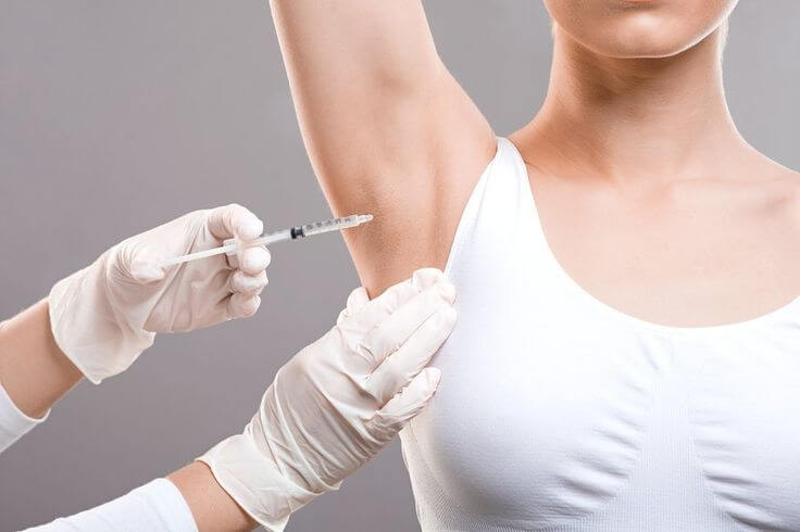 Hyperhidrosis or Excessive Sweating Treatment by Botox