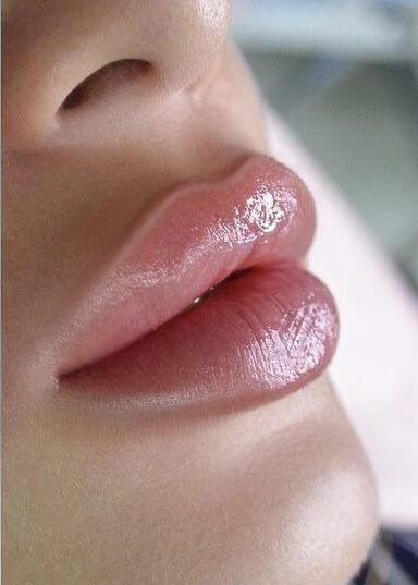 Filler injection